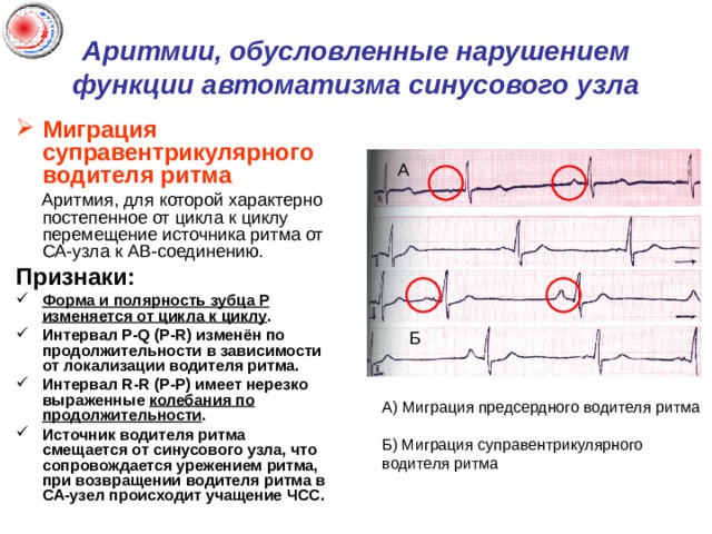 Аритмии, обусловленные нарушением функции автоматизма синусового узла Миграция суправентрикулярного водителя ритма  Аритмия, для которой характерно постепенное от цикла к циклу перемещение источника ритма от СА-узла к АВ-соединению. Признаки: Форма и полярность зубца P изменяется от цикла к циклу . Интервал P-Q (P-R) изменён по продолжительности в зависимости от локализации водителя ритма. Интервал R-R (P-P) имеет нерезко выраженные колебания по продолжительности . Источник водителя ритма смещается от синусового узла, что сопровождается урежением ритма, при возвращении водителя ритма в СА-узел происходит учащение ЧСС.  А Б А) Миграция предсердного водителя ритма Б) Миграция суправентрикулярного водителя ритма 