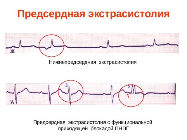 Предсердная экстрасистолия Нижнепредсердная экстрасистолия Предсердная экстрасистолия с функциональной  приходящей блокадой ПНПГ 