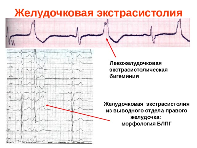 Желудочковая экстрасистолия  Левожелудочковая экстрасистолическая бигеминия Желудочковая экстрасистолия  из выводного отдела правого желудочка: морфология БЛПГ  