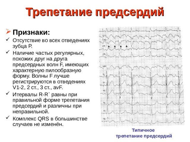 Трепетание предсердий на экг