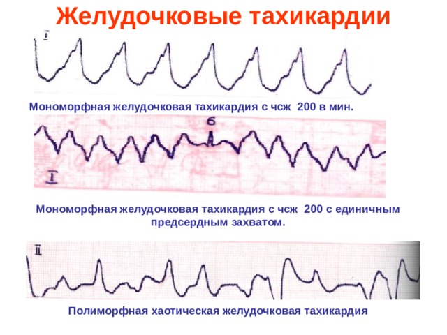 Желудочковые тахикардии   Мономорфная желудочковая тахикардия с чсж 200 в мин. Мономорфная желудочковая тахикардия с чсж 200 с единичным предсердным захватом. Полиморфная хаотическая желудочковая тахикардия 