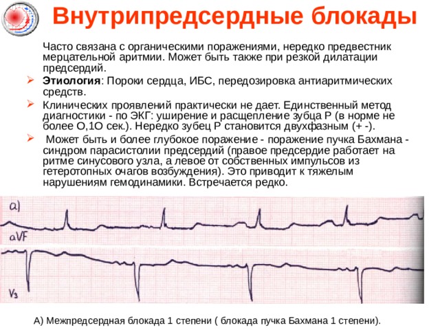 Внутрипредсердные блокады    Часто связана с органическими поражениями, нередко предвестник мерцательной аритмии. Может быть также при резкой дилатации предсердий. Этиология : Пороки сердца, ИБС, передозировка антиаритмических средств. Клинических проявлений практически не дает. Единственный метод диагностики - по ЭКГ: уширение и расщепление зубца Р (в норме не более О,1О сек.). Нередко зубец Р становится двухфазным (+ -).  Может быть и более глубокое поражение - поражение пучка Бахмана - синдром парасистолии предсердий (правое предсердие работает на ритме синусового узла, а левое от собственных импульсов из гетеротопных очагов возбуждения). Это приводит к тяжелым нарушениям гемодинамики. Встречается редко.        А) Межпредсердная блокада 1 степени ( блокада пучка Бахмана 1 степени). 