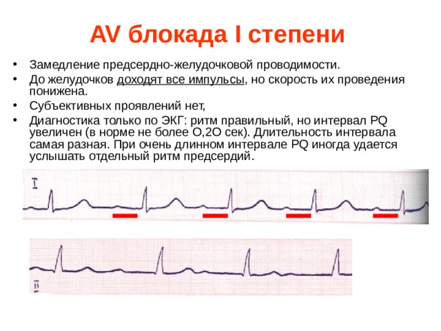 AV блокада I степени   Замедление предсердно-желудочковой проводимости. До желудочков доходят все импульсы , но скорость их проведения понижена. Субъективных проявлений нет, Диагностика только по ЭКГ: ритм правильный, но интервал PQ увеличен (в норме не более О,2О сек). Длительность интервала самая разная. При очень длинном интервале PQ иногда удается услышать отдельный ритм предсердий.  