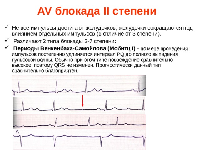 AV блокада II степени   Не все импульсы достигают желудочков, желудочки сокращаются под влиянием отдельных импульсов (в отличие от 3 степени).  Различают 2 типа блокады 2-й степени:   Периоды Венкенбаха-Самойлова (Мобитц I) - по мере проведения импульсов постепенно удлиняется интервал PQ до полного выпадения пульсовой волны. Обычно при этом типе повреждение сравнительно высокое, поэтому QRS не изменен. Прогностически данный тип сравнительно благоприятен.   