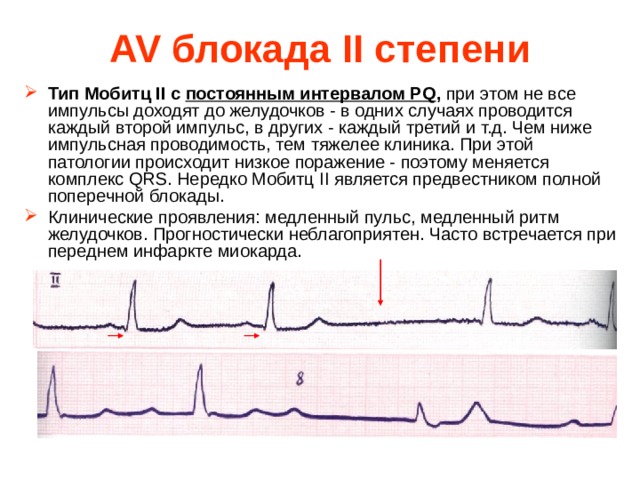 AV блокада II степени Тип Мобитц II с постоянным интервалом PQ , при этом не все импульсы доходят до желудочков - в одних случаях проводится каждый второй импульс, в других - каждый третий и т.д. Чем ниже импульсная проводимость, тем тяжелее клиника. При этой патологии происходит низкое поражение - поэтому меняется комплекс QRS. Нередко Мобитц II является предвестником полной поперечной блокады. Клинические проявления: медленный пульс, медленный ритм желудочков. Прогностически неблагоприятен. Часто встречается при переднем инфаркте миокарда. 