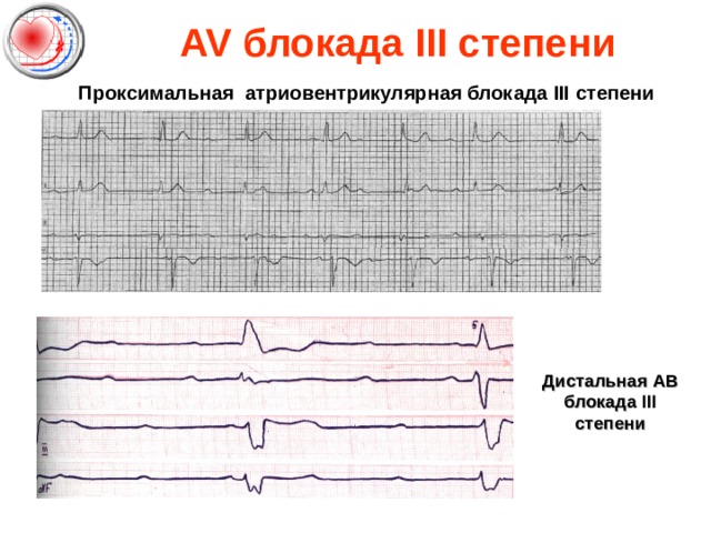 AV блокада III степени Проксимальная атриовентрикулярная блокада III степени  Дистальная АВ блокада III степени 