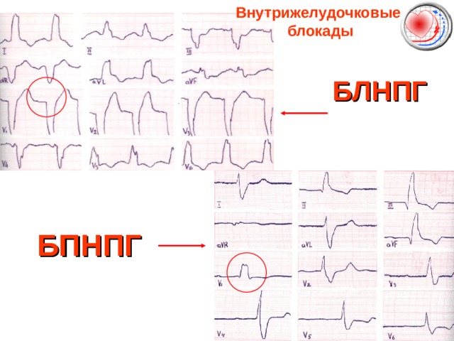 Внутрижелудочковые  блокады БЛНПГ БПНПГ 