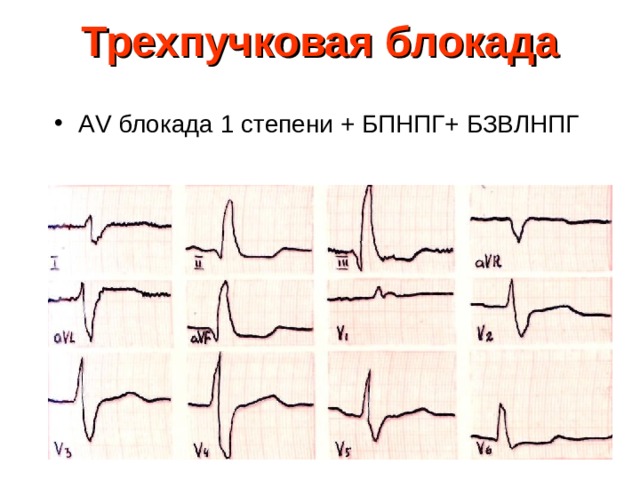 Трехпучковая блокада А V блокада 1 степени + БПНПГ+ БЗВЛНПГ 