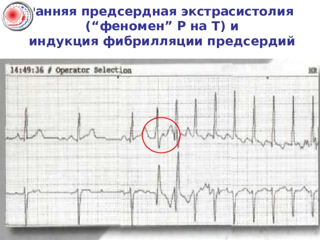 Ранняя предсердная экстрасистолия  ( “ феномен ” Р на Т) и  индукция фибрилляции предсердий 