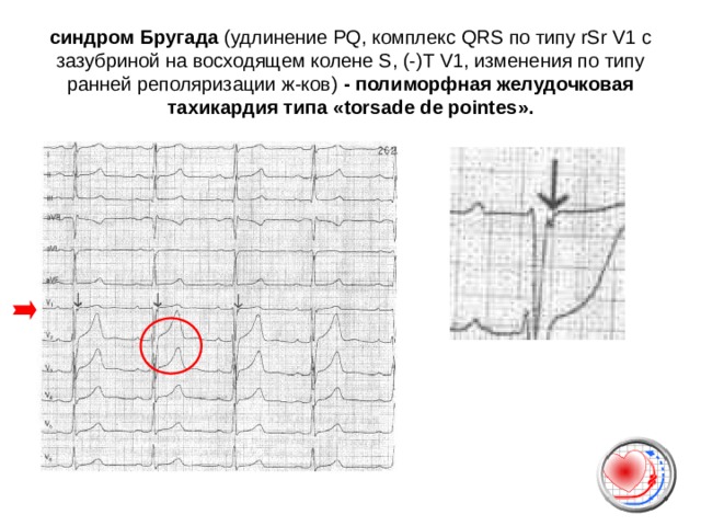 синдром Бругада (удлинение PQ , комплекс QRS по типу rSr V1 c зазубриной на восходящем колене S , (-)Т V1 , изменения по типу ранней реполяризации ж-ков) - полиморфная желудочковая тахикардия типа  « torsade de pointes ».   