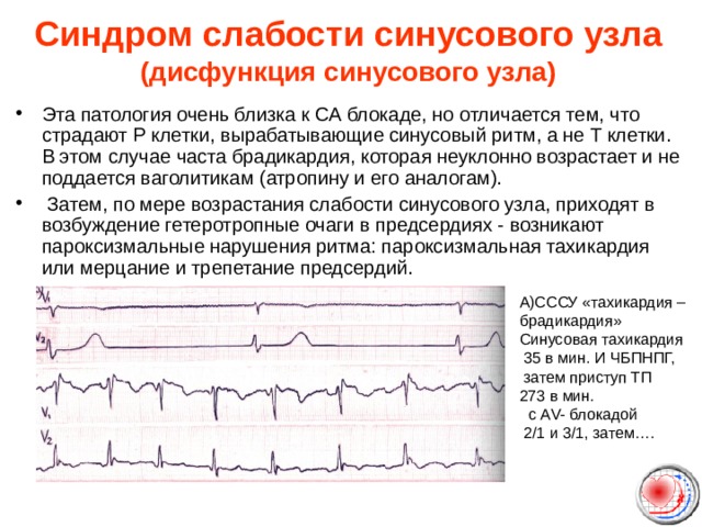 Синдром слабости синусового узла  (дисфункция синусового узла)   Эта патология очень близка к СА блокаде, но отличается тем, что страдают Р клетки, вырабатывающие синусовый ритм, а не Т клетки. В этом случае часта брадикардия, которая неуклонно возрастает и не поддается ваголитикам (атропину и его аналогам).  Затем, по мере возрастания слабости синусового узла, приходят в возбуждение гетеротропные очаги в предсердиях - возникают пароксизмальные нарушения ритма: пароксизмальная тахикардия или мерцание и трепетание предсердий. А)СССУ « тахикардия – брадикардия » Синусовая тахикардия  35 в мин. И ЧБПНПГ,  затем приступ ТП 273 в мин.   c А V- блокадой  2/1 и 3/1, затем…. 