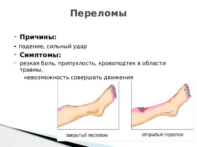 Закрытый перелом симптомы