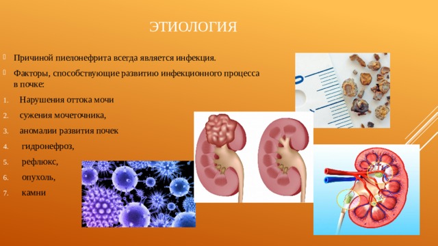 Сестринская помощь при мочекаменной болезни презентация