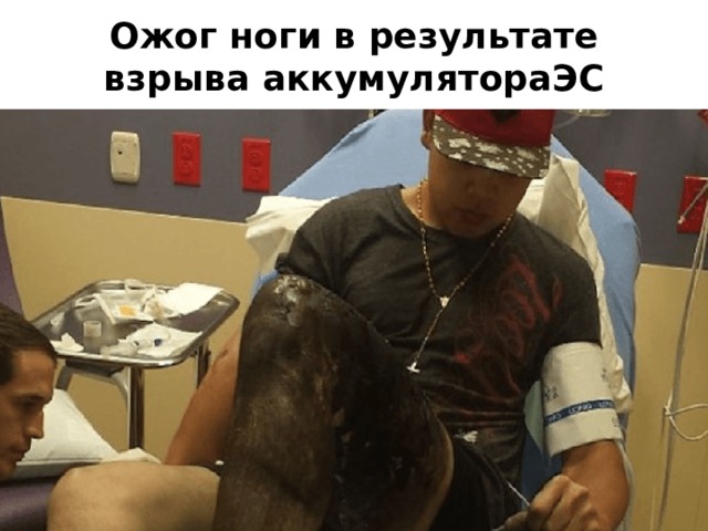 Ожог ноги в результате взрыва аккумулятораЭС 