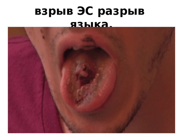 взрыв ЭС разрыв языка. 