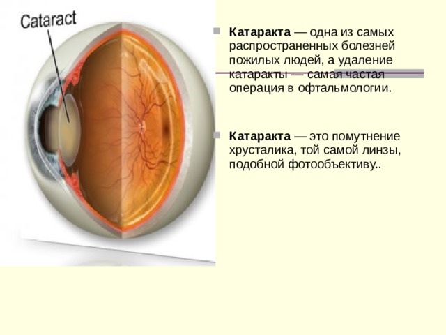 Катаракта — одна из самых распространенных болезней пожилых людей, а удаление катаракты — самая частая операция в офтальмологии.    Катаракта — это помутнение хрусталика, той самой линзы, подобной фотообъективу.. 