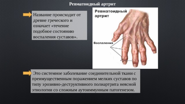 Ревматоидный артрит Название происходит от древне греческого и означает «течение подобное состоянию воспаления суставов».  Это системное заболевание соединительной ткани с преимущественным поражением мелких суставов по типу эрозивно-деструктивного полиартрита неясной этиологии со сложным аутоиммунным патогенезом. 