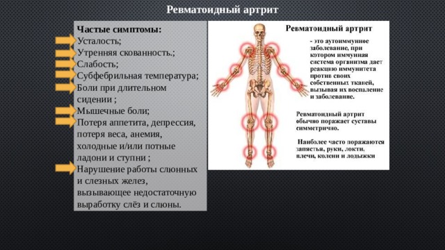 Ревматоидный артрит Частые симптомы: Усталость; Утренняя скованность.; Слабость; Субфебрильная температура; Боли при длительном сидении ; Мышечные боли; Потеря аппетита, депрессия, потеря веса, анемия, холодные и/или потные ладони и ступни ; Нарушение работы слюнных и слезных желез, вызывающее недостаточную выработку слёз и слюны. 