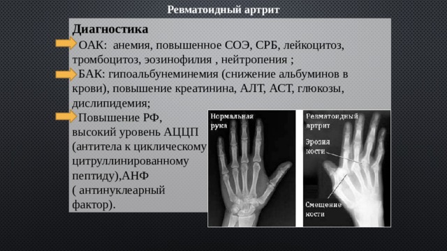 Ревматоидный артрит Диагностика  ОАК: анемия, повышенное СОЭ, СРБ, лейкоцитоз, тромбоцитоз, эозинофилия , нейтропения ;  БАК: гипоальбунеминемия (снижение альбуминов в крови), повышение креатинина, АЛТ, АСТ, глюкозы, дислипидемия;  Повышение РФ, высокий уровень АЦЦП (антитела к циклическому цитруллинированному пептиду),АНФ ( антинуклеарный фактор). 