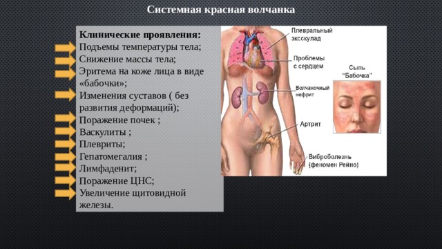 Системная красная волчанка Клинические проявления: Подъемы температуры тела; Снижение массы тела; Эритема на коже лица в виде «бабочки»; Изменения суставов ( без развития деформаций); Поражение почек ; Васкулиты ; Плевриты; Гепатомегалия ; Лимфаденит; Поражение ЦНС; Увеличение щитовидной железы. 