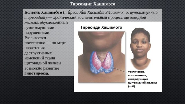 Тиреоидит Хашимото Болезнь Хашимо́то ( ти́реоиди́т Хасимо́то/Хашимото , аутоиммунный тиреоидит ) — хронический воспалительный процесс щитовидной железы, обусловленный аутоиммунными нарушениями. Развивается постепенно — по мере нарастания деструктивных изменений ткани щитовидной железы возможно развитие гипотиреоза . 