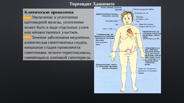 Тиреоидит Хашимото Клинические проявления  Увеличение и уплотнение щитовидной железы, уплотнение может быть в виде отдельных узлов или множественных участков.  Течение заболевания медленное, клиническая симптоматика скудна, начальные стадии проявляются симптомами легкого-тиреотоксикоза, сменяющееся клиникой гипотиреоза. 