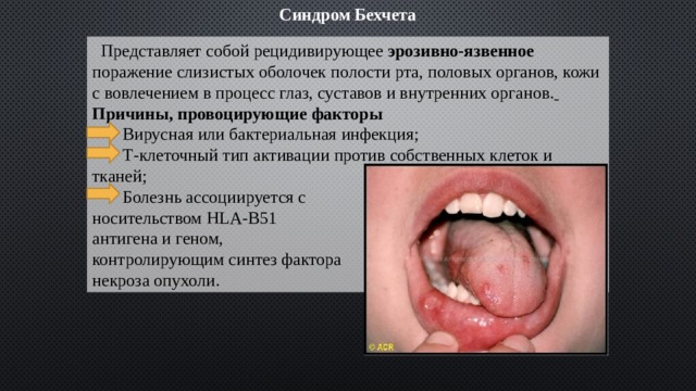 Синдром Бехчета  Представляет собой рецидивирующее эрозивно-язвенное поражение слизистых оболочек полости рта, половых органов, кожи с вовлечением в процесс глаз, суставов и внутренних органов.  Причины, провоцирующие факторы  Вирусная или бактериальная инфекция;  Т-клеточный тип активации против собственных клеток и тканей;  Болезнь ассоциируется с носительством HLA-B51 антигена и геном, контролирующим синтез фактора некроза опухоли. 