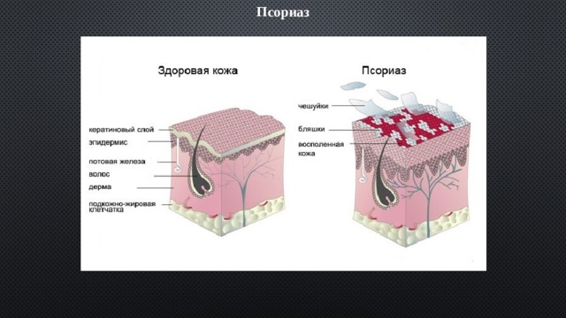 Псориаз 