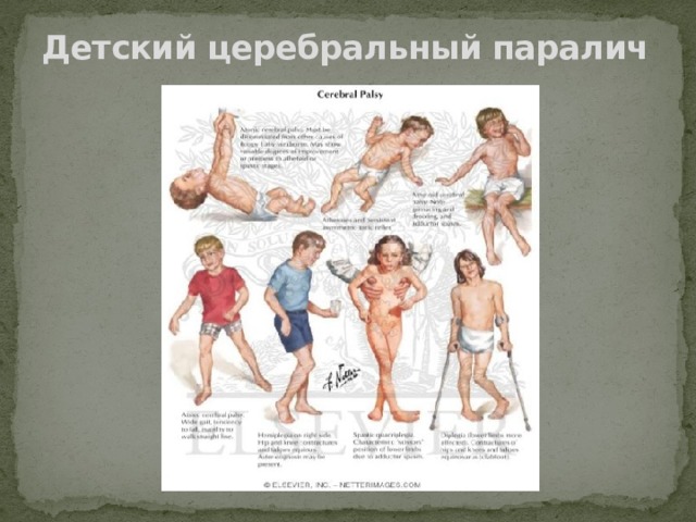 Детский церебральный паралич 