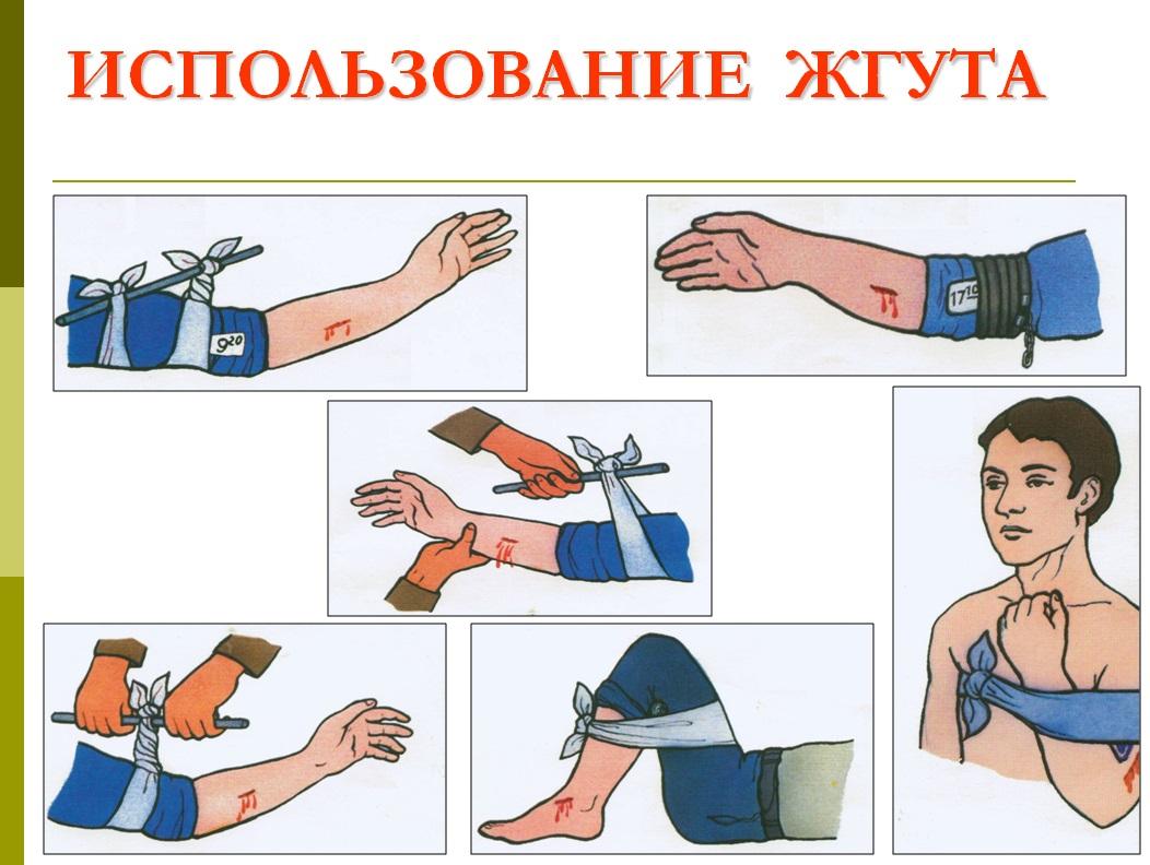 Правильный жгут. Правила использования жгута. Места накладывания жгута. Наложение жгута на предплечье.