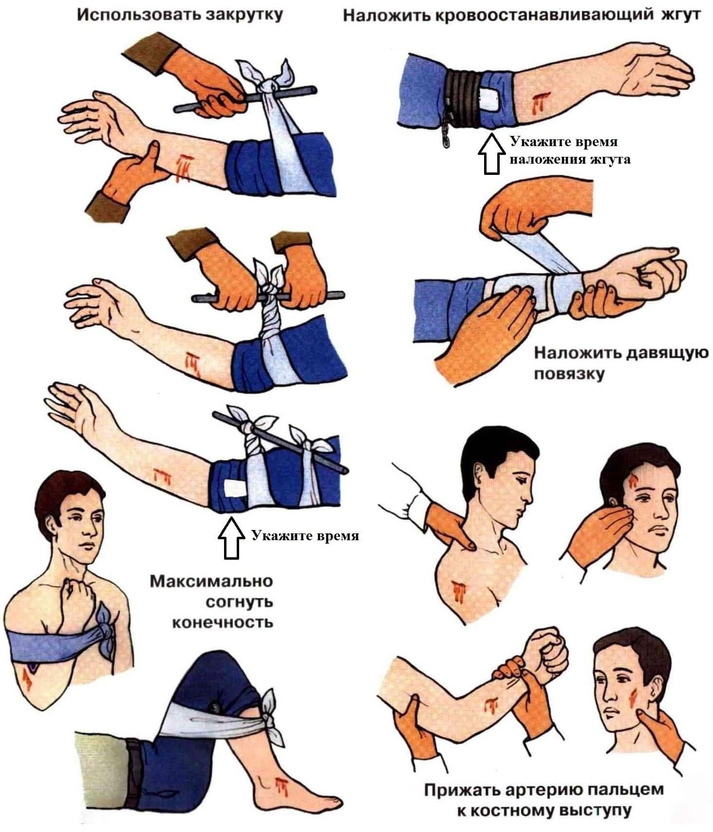 Наложение давящей повязки рисунок