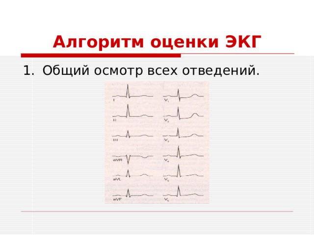 Алгоритм оценки ЭКГ Общий осмотр всех отведений. 