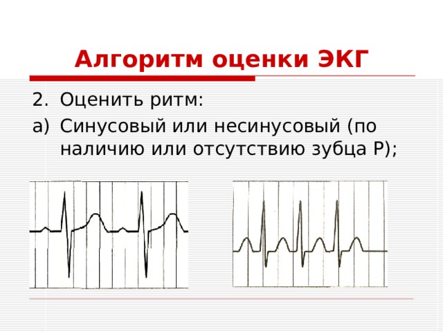 Алгоритм оценки ЭКГ Оценить ритм: Синусовый или несинусовый (по наличию или отсутствию зубца Р); 