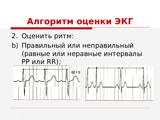 Алгоритм оценки ЭКГ Оценить ритм: Правильный или неправильный (равные или неравные интервалы РР или RR) ; 