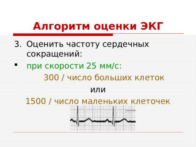 Алгоритм оценки ЭКГ Оценить частоту сердечных сокращений: при скорости 25 мм/с:  300 / число больших клеток или 1500 / число маленьких клеточек 