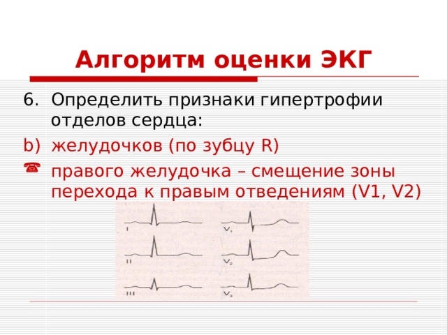 Алгоритм оценки ЭКГ Определить признаки гипертрофии отделов сердца: желудочков (по зубцу R ) правого желудочка – смещение зоны перехода  к правым отведениям (V 1 ,  V 2) 