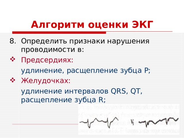 Алгоритм оценки ЭКГ Определить признаки нарушения проводимости в: Предсердиях:  удлинение, расщепление зубца Р; Желудочках:  удлинение интервалов QRS, QT, расщепление зубца R ; 
