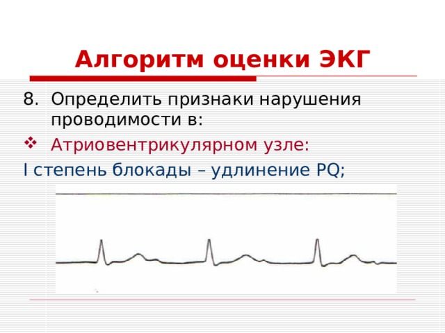 Алгоритм оценки ЭКГ Определить признаки нарушения проводимости в: Атриовентрикулярном узле: I степень блокады – удлинение PQ ; 