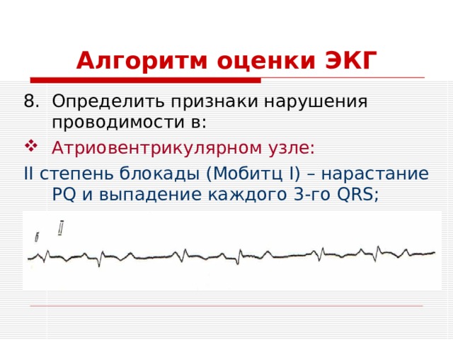 Алгоритм оценки ЭКГ Определить признаки нарушения проводимости в: Атриовентрикулярном узле: II степень блокады (Мобитц I) – нарастание PQ и выпадение каждого 3 - го QRS ; 