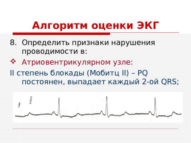 Алгоритм оценки ЭКГ Определить признаки нарушения проводимости в: Атриовентрикулярном узле: II степень блокады (Мобитц II) –  PQ постоянен, выпадает каждый 2-ой QRS ; 