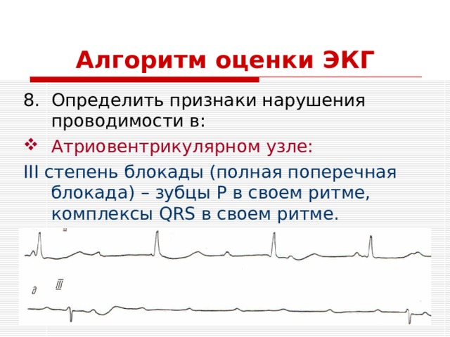 Алгоритм оценки ЭКГ Определить признаки нарушения проводимости в: Атриовентрикулярном узле: III степень блокады (полная поперечная блокада) – зубцы Р в своем ритме, комплексы QRS в своем ритме. Любов А.С. 