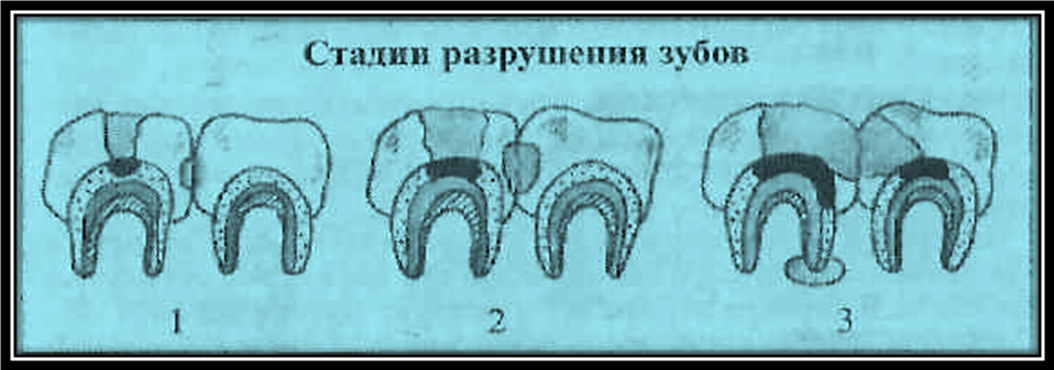 Рассмотрите рисунки 1 4 с изображением зуба человека как называется заболевание зуба стадии развития