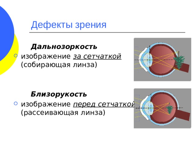 При дальнозоркости изображение возникает перед сетчаткой на сетчатке