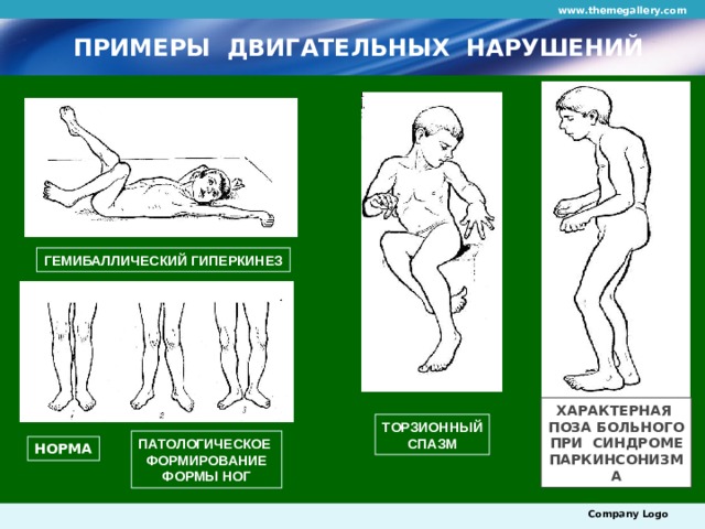 www.themegallery.com ПРИМЕРЫ ДВИГАТЕЛЬНЫХ НАРУШЕНИЙ ГЕМИБАЛЛИЧЕСКИЙ ГИПЕРКИНЕЗ ХАРАКТЕРНАЯ ПОЗА БОЛЬНОГО ПРИ СИНДРОМЕ ПАРКИНСОНИЗМА ТОРЗИОННЫЙ СПАЗМ ПАТОЛОГИЧЕСКОЕ ФОРМИРОВАНИЕ ФОРМЫ НОГ НОРМА Company Logo 