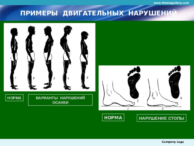 www.themegallery.com ПРИМЕРЫ ДВИГАТЕЛЬНЫХ НАРУШЕНИЙ ВАРИАНТЫ НАРУШЕНИЙ ОСАНКИ НОРМА НОРМА НАРУШЕНИЕ СТОПЫ Company Logo 