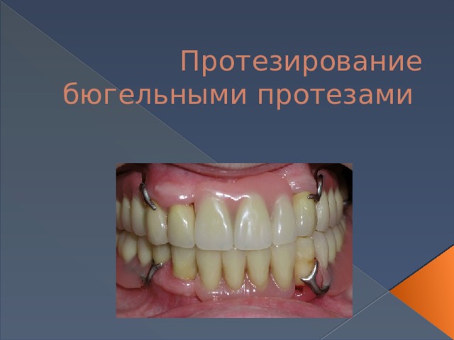 Протезирование бюгельными протезами 