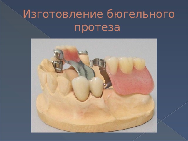 Изготовление бюгельного протеза 