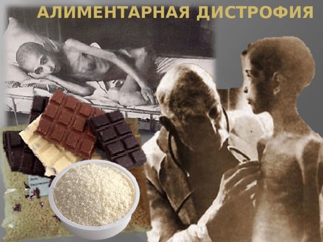 Алиментарная дистрофия 
