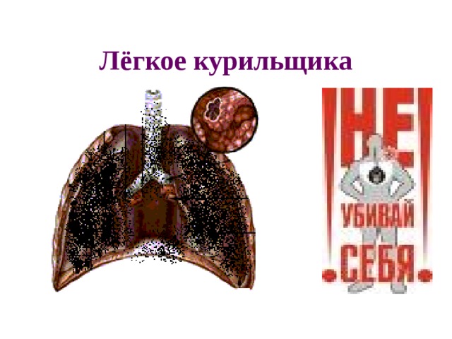 Лёгкое курильщика 