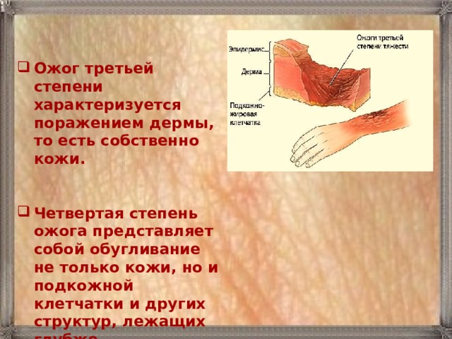 Ожог третьей степени характеризуется поражением дермы, то есть собственно кожи.   Четвертая степень ожога представляет собой обугливание не только кожи, но и подкожной клетчатки и других структур, лежащих глубже. 